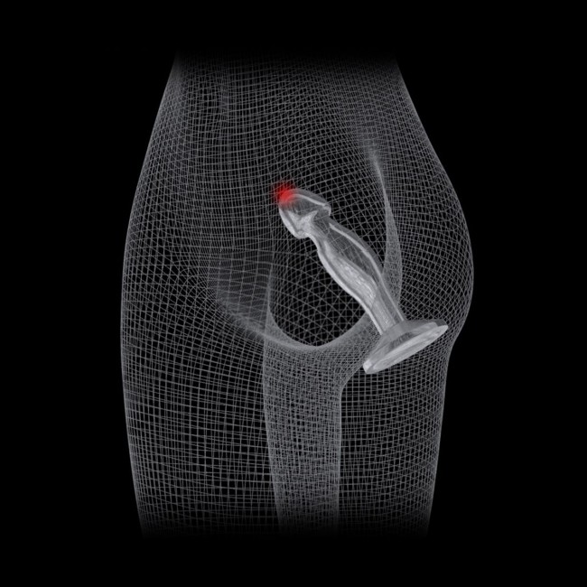 Plug Anal Transparente